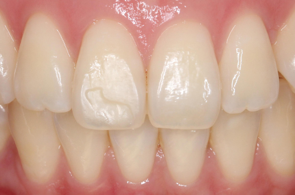 アイコンによる白斑 ホワイトスポット治療 群馬県前橋市のくすのき歯科 矯正歯科
